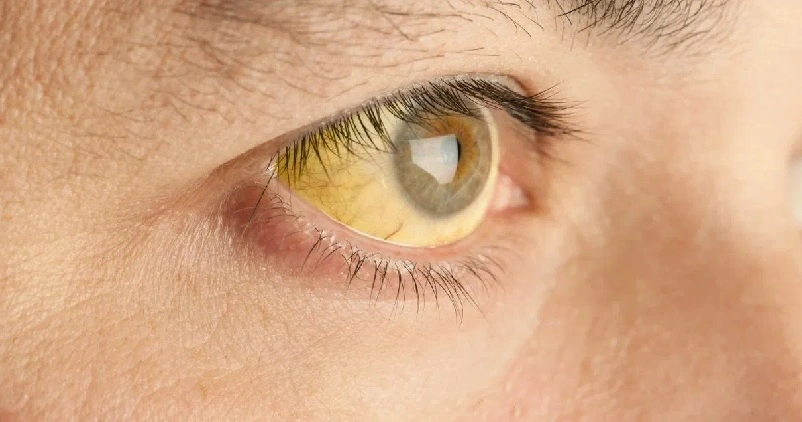 മഞ്ഞപ്പിത്തം; ലക്ഷണങ്ങളും ആഹാരത്തിൽ ശ്രദ്ധിക്കേണ്ട കാര്യങ്ങളും