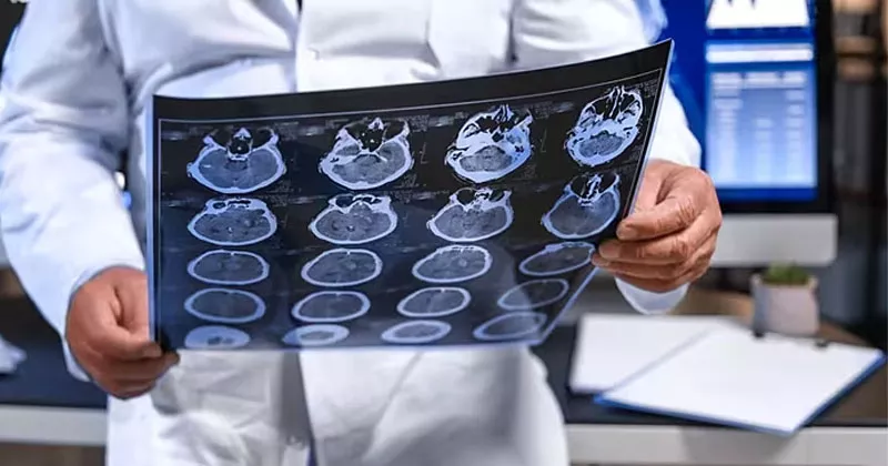 35 ശതമാനത്തിന്റെ വർധനവ്; അയർലൻഡിൽ ബ്രെയ്ൻ ട്യൂമർ ബാധിതരുടെ എണ്ണം വർധിക്കുന്നു brain tomour